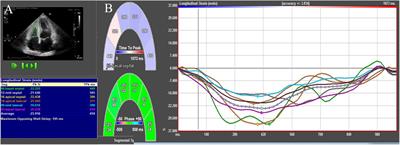 Evaluation of Right Ventricular Myocardial Mechanics by 2- and 3-Dimensional Speckle-Tracking Echocardiography in Patients With an Ischemic or Non-ischemic Etiology of End-Stage Heart Failure